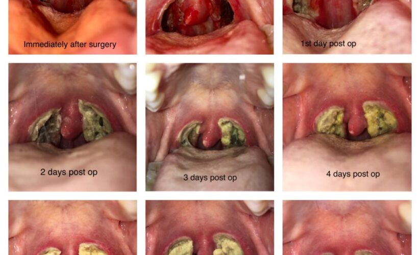 Essential Guide to Tonsillectomy Diet for Your Child: Practical Tips for 2025